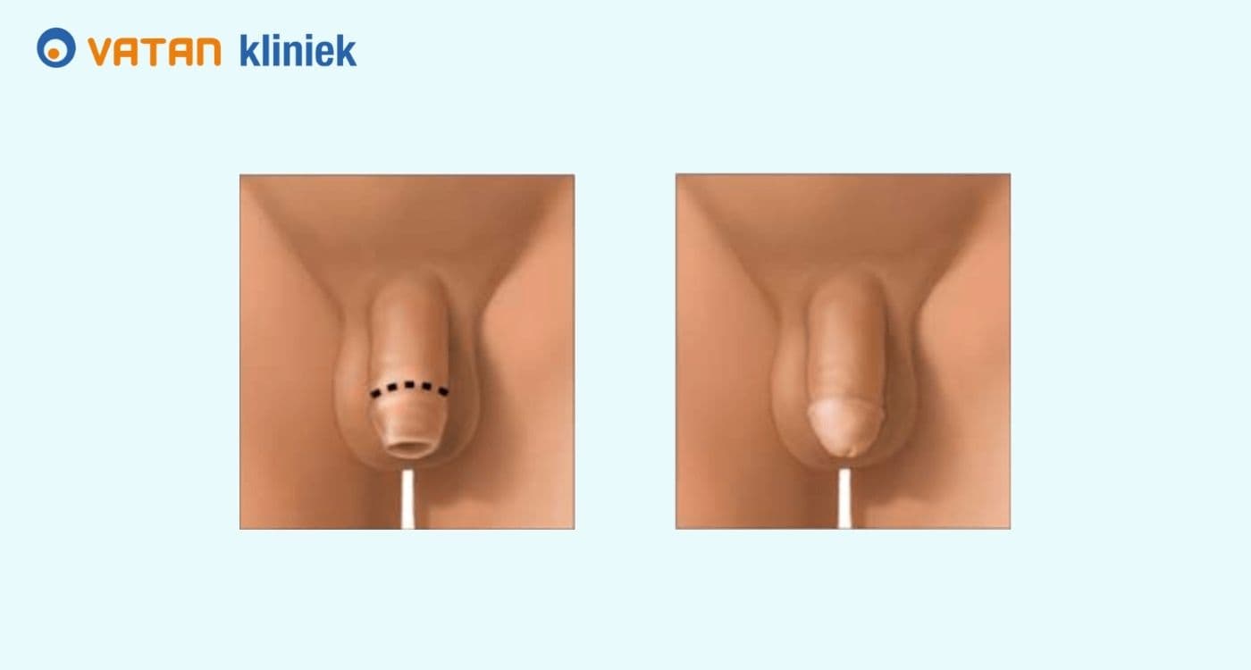 Besnijdenis betekenis: Een complete uitleg