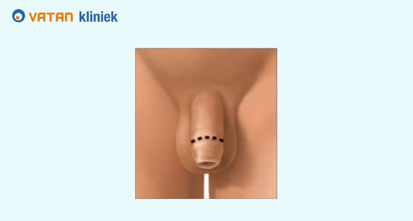 Te lange voorhuid: Wanneer is een behandeling nodig?